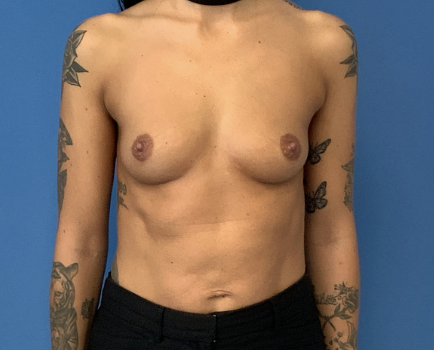 Breast-Augmentation--Case-Study-7034 | Before Breast Augmentation